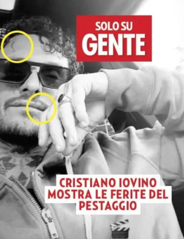 Cristiano Iovino i segni sul volto dopo il pestaggio su Gente